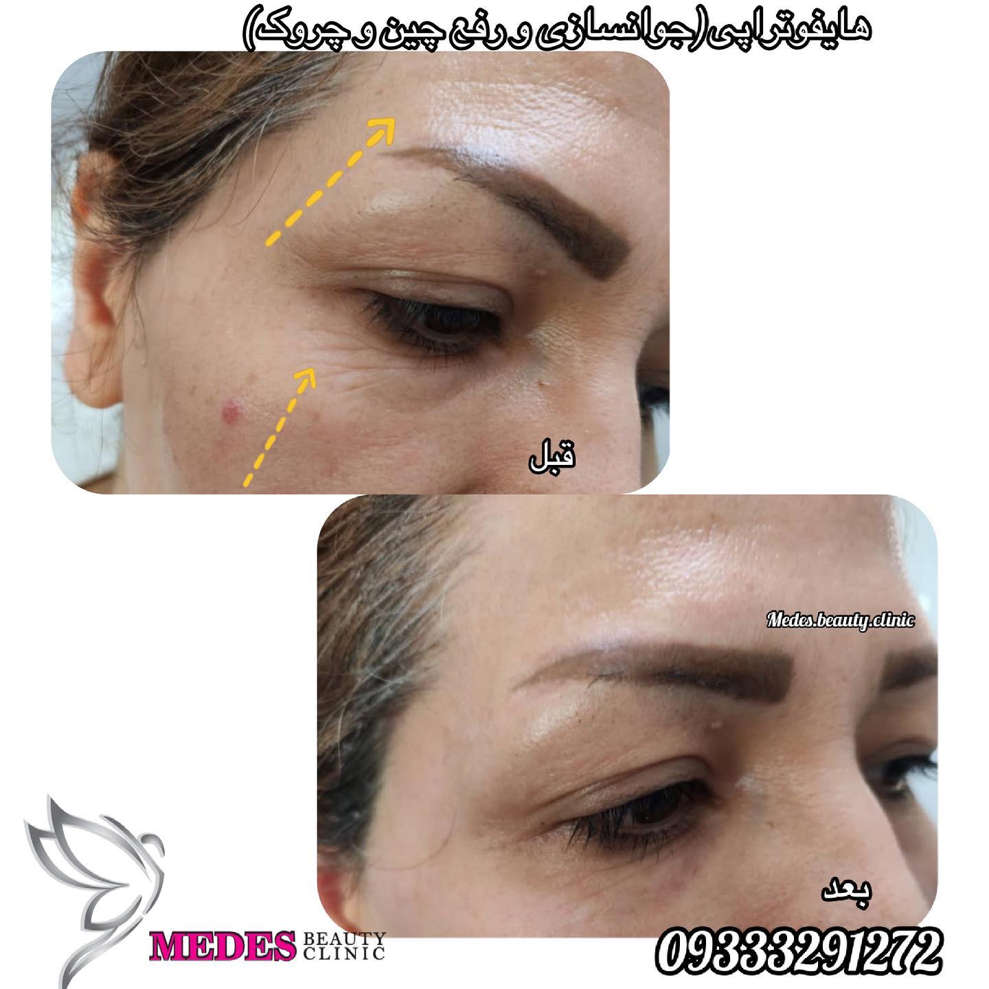 گالری هایفوتراپی